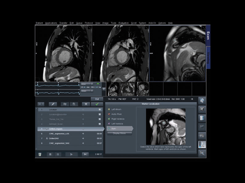 Μαγνητική Τομογραφία Καρδιάς