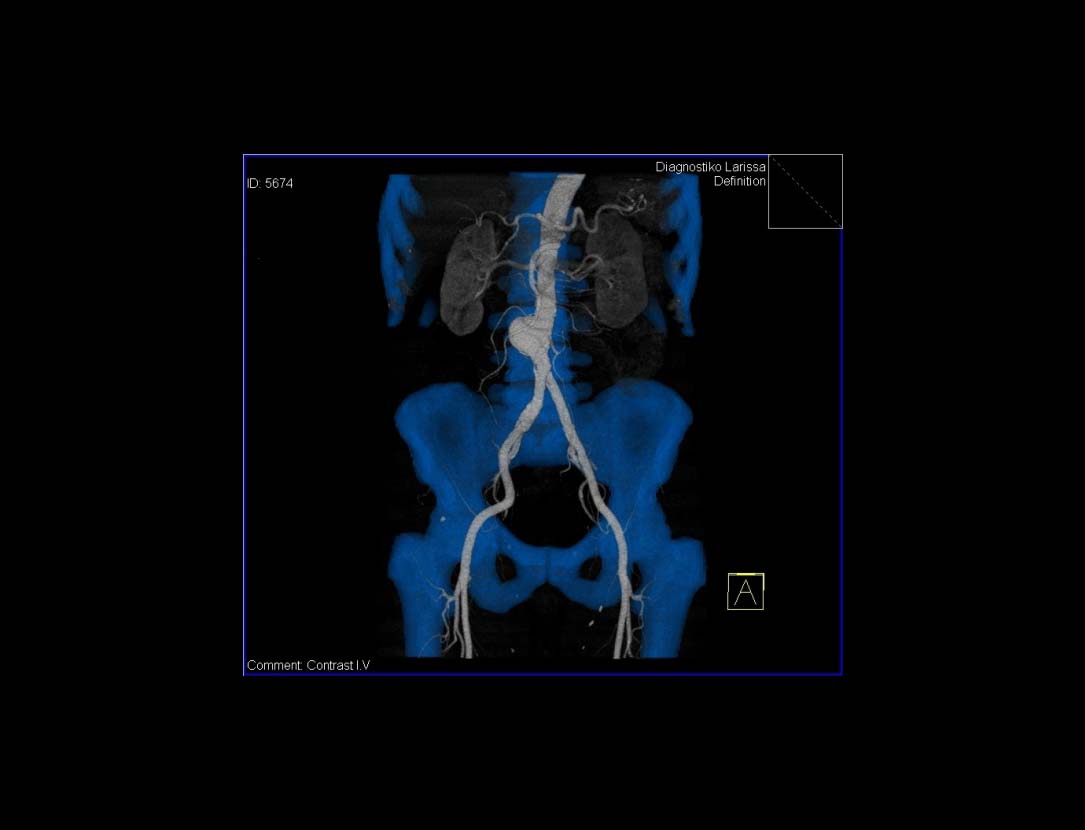 Αξονική Αγγειογραφία