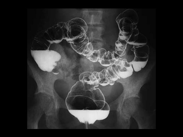 ακτινογραφία λαρισα